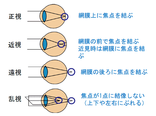 １ 子どもの眼の屈折と見え方 第回子どもの眼の健康ii 養護教諭のお仕事 特集 学校保健ポータルサイト