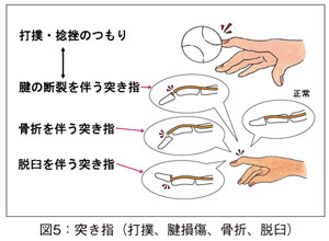 図5：突き指（打撲、腱損傷、骨折、脱臼）