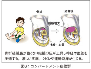 図6：コンパートメント症候群